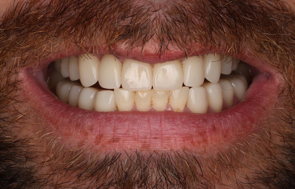 Post-op close-up — full smile restored.