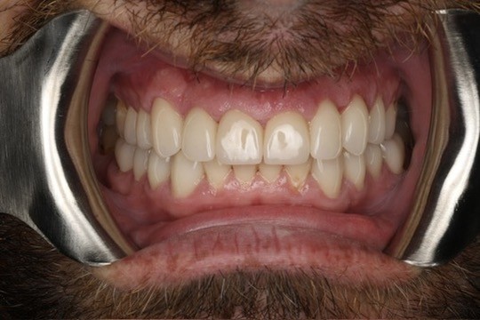 Post-op intraoral view — teeth fully restored.